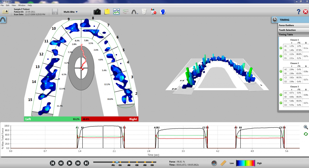 Dental Occlusal Equilibration Occlusal Analysis & Adjustment Tekscan